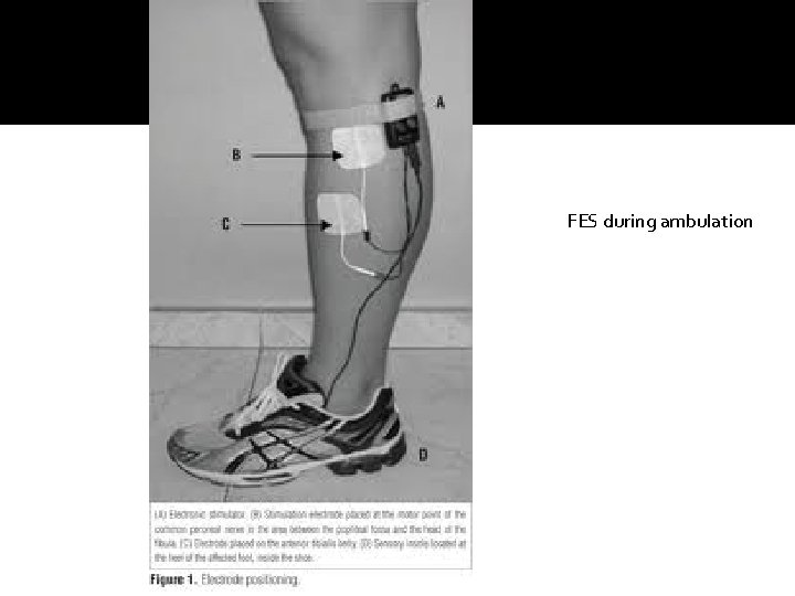 FES during ambulation FES during ambulation