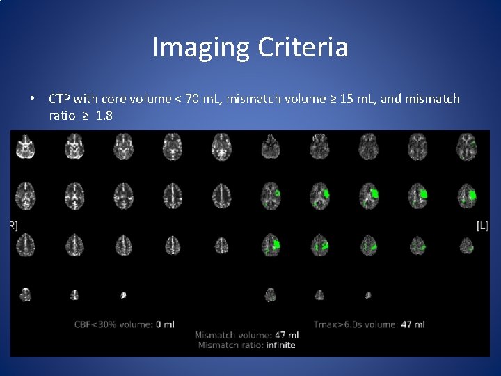 Imaging Criteria • CTP with core volume < 70 m. L, mismatch volume ≥