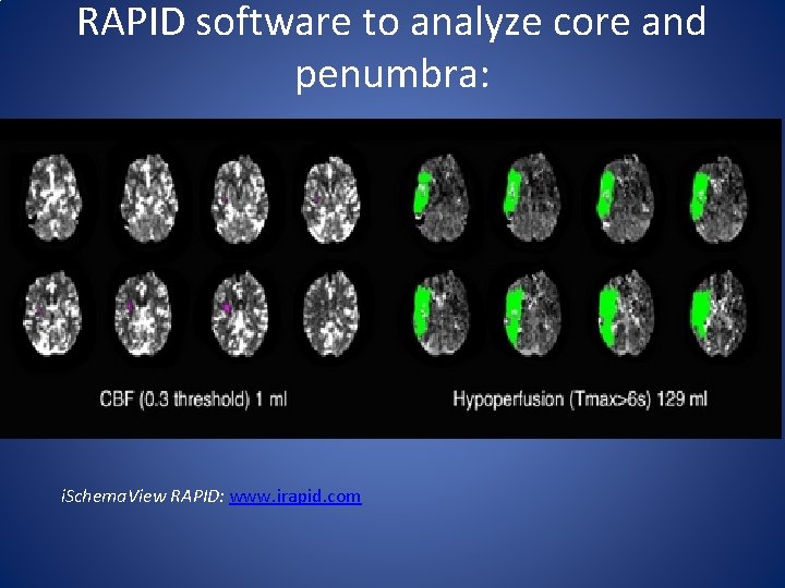RAPID software to analyze core and penumbra: i. Schema. View RAPID: www. irapid. com