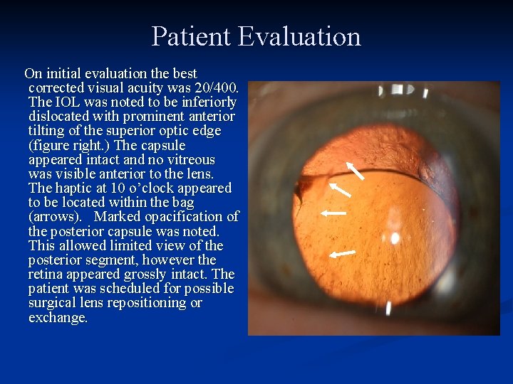 Patient Evaluation On initial evaluation the best corrected visual acuity was 20/400. The IOL