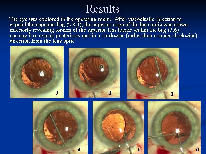 Results The eye was explored in the operating room. After viscoelastic injection to expand