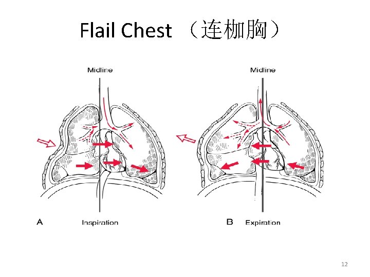 Flail Chest （连枷胸） 12 