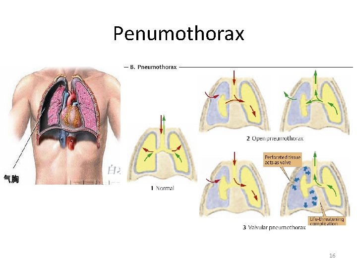 Penumothorax 16 