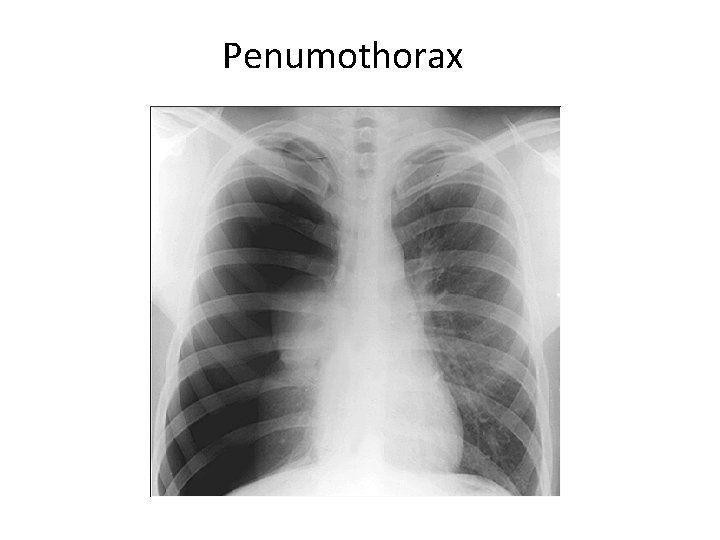 Penumothorax 