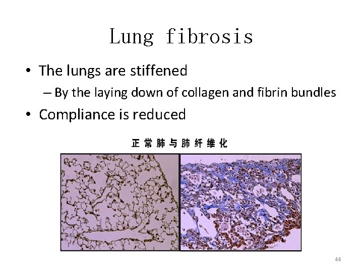 Lung fibrosis • The lungs are stiffened – By the laying down of collagen