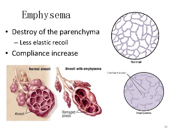 Emphysema • Destroy of the parenchyma – Less elastic recoil • Compliance increase 45