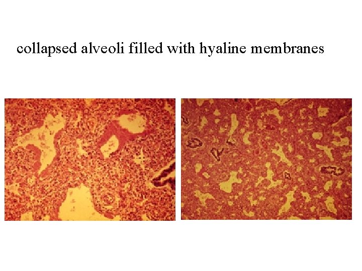 collapsed alveoli filled with hyaline membranes 