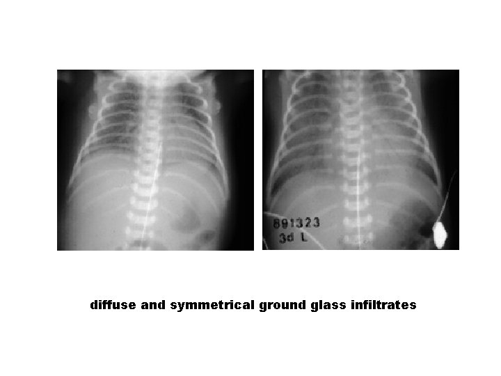 diffuse and symmetrical ground glass infiltrates 