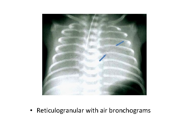  • Reticulogranular with air bronchograms 