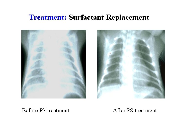 Treatment: Surfactant Replacement Before PS treatment After PS treatment 