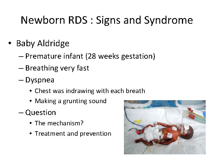 Newborn RDS : Signs and Syndrome • Baby Aldridge – Premature infant (28 weeks