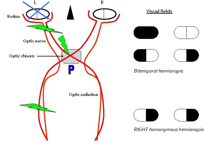 L R Visual fields Retina Optic nerve Optic chiasm Bitemporal hemianopia Optic radiation RIGHT