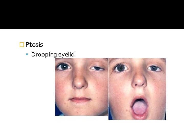 � Ptosis Drooping eyelid 