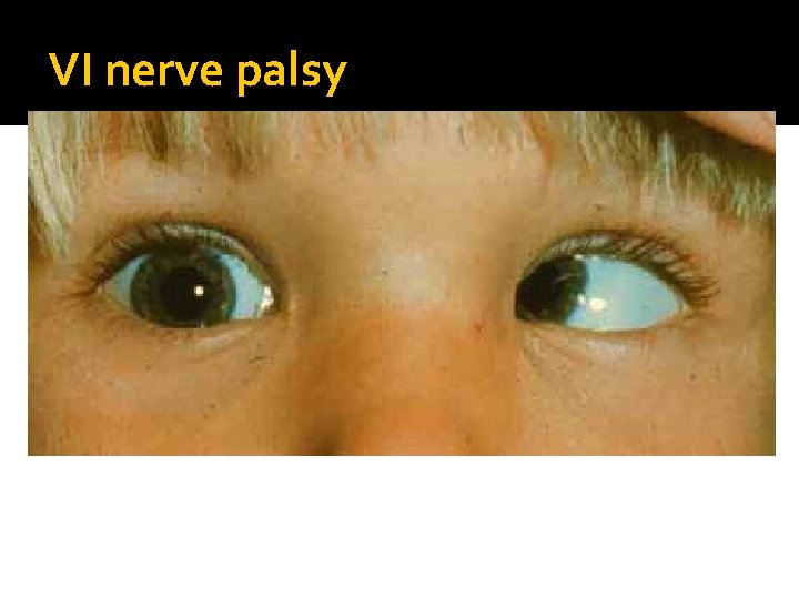 VI nerve palsy 