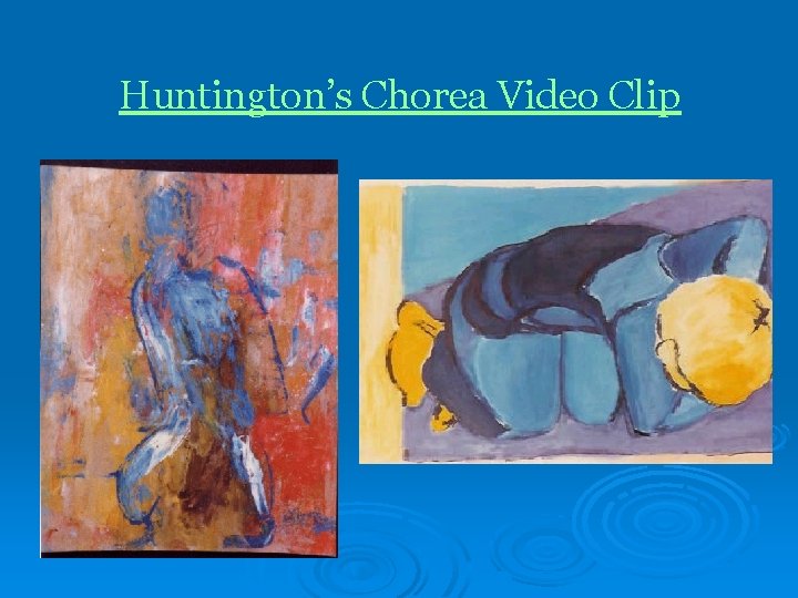 Huntington’s Chorea Video Clip 
