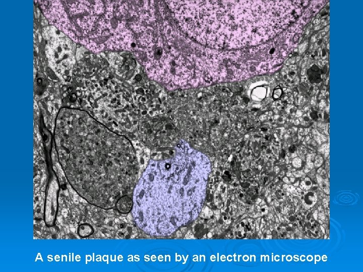 A senile plaque as seen by an electron microscope 