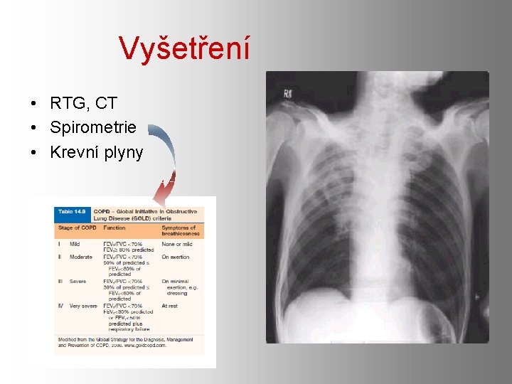 Vyšetření • RTG, CT • Spirometrie • Krevní plyny 