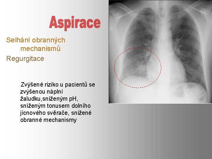 Selhání obranných mechanismů Regurgitace Zvýšené riziko u pacientů se zvýšenou náplní žaludku, sníženým p.