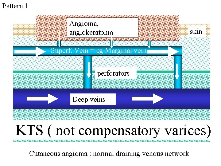 Pattern 1 Angioma, angiokeratoma skin Superf. Vein = eg Marginal vein perforators Deep veins Pattern 1 Angioma, angiokeratoma skin Superf. Vein = eg Marginal vein perforators Deep veins