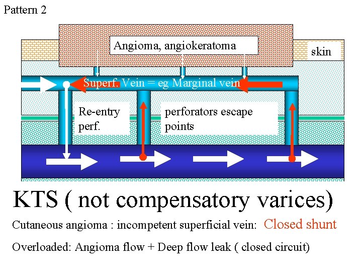 Pattern 2 Angioma, angiokeratoma skin Superf. Vein = eg Marginal vein Re-entry perforators escape Pattern 2 Angioma, angiokeratoma skin Superf. Vein = eg Marginal vein Re-entry perforators escape