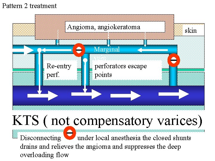 Pattern 2 treatment Angioma, angiokeratoma Re-entry perf. skin Marginal vein perforators escape points KTS Pattern 2 treatment Angioma, angiokeratoma Re-entry perf. skin Marginal vein perforators escape points KTS