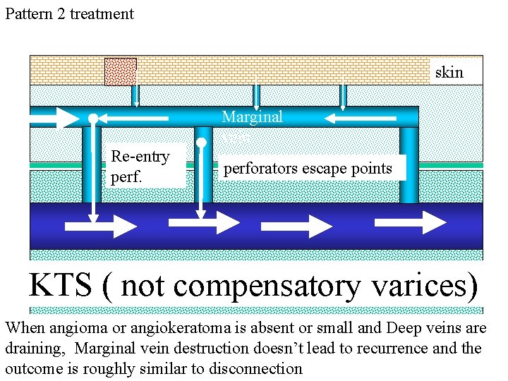 Pattern 2 treatment skin Marginal vein Re-entry perforators escape points KTS ( not compensatory Pattern 2 treatment skin Marginal vein Re-entry perforators escape points KTS ( not compensatory