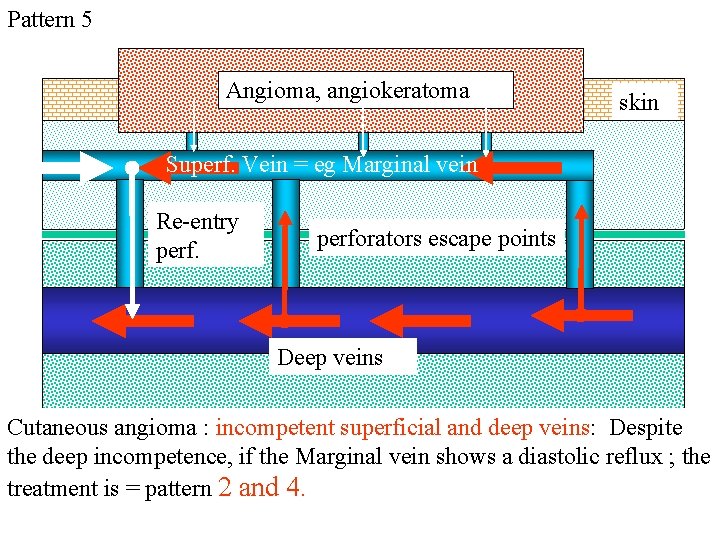 Pattern 5 Angioma, angiokeratoma skin Superf. Vein = eg Marginal vein Re-entry perforators escape Pattern 5 Angioma, angiokeratoma skin Superf. Vein = eg Marginal vein Re-entry perforators escape