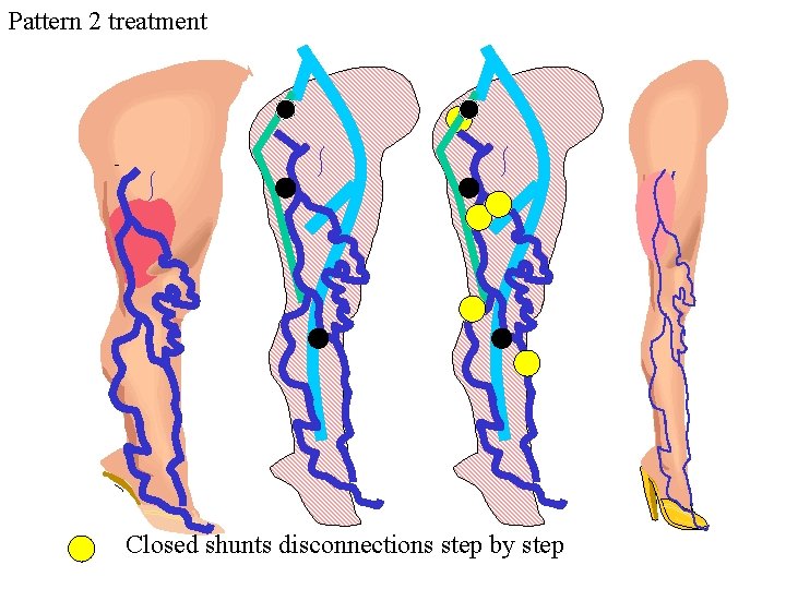 Pattern 2 treatment Closed shunts disconnections step by step Pattern 2 treatment Closed shunts disconnections step by step