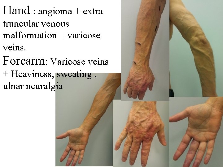 Hand : angioma + extra truncular venous malformation + varicose veins. Forearm: Varicose veins Hand : angioma + extra truncular venous malformation + varicose veins. Forearm: Varicose veins