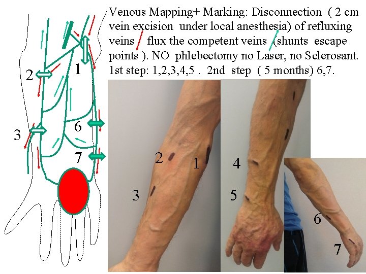 2 3 1 Venous Mapping+ Marking: Disconnection ( 2 cm vein excision under local 2 3 1 Venous Mapping+ Marking: Disconnection ( 2 cm vein excision under local
