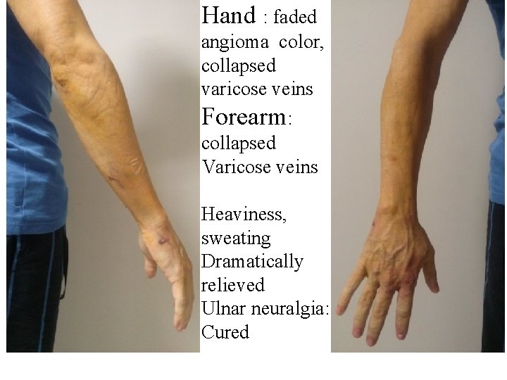 Hand : faded angioma color, collapsed varicose veins Forearm: collapsed Varicose veins Heaviness, sweating Hand : faded angioma color, collapsed varicose veins Forearm: collapsed Varicose veins Heaviness, sweating