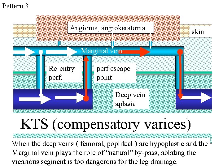 Pattern 3 Angioma, angiokeratoma skin Marginal vein Re-entry perf escape point Deep vein aplasia Pattern 3 Angioma, angiokeratoma skin Marginal vein Re-entry perf escape point Deep vein aplasia