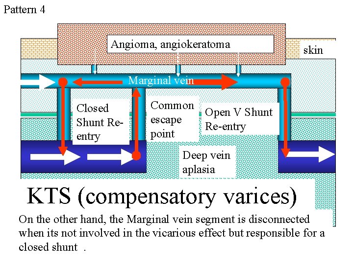 Pattern 4 Angioma, angiokeratoma skin Marginal vein Closed Shunt Reentry Common Open V Shunt Pattern 4 Angioma, angiokeratoma skin Marginal vein Closed Shunt Reentry Common Open V Shunt