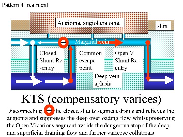 Pattern 4 treatment Angioma, angiokeratoma skin Marginal vein Closed Shunt Re -entry Common Open Pattern 4 treatment Angioma, angiokeratoma skin Marginal vein Closed Shunt Re -entry Common Open