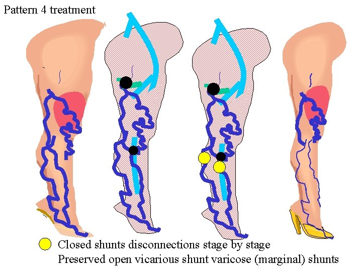 Pattern 4 treatment Closed shunts disconnections stage by stage Preserved open vicarious shunt varicose Pattern 4 treatment Closed shunts disconnections stage by stage Preserved open vicarious shunt varicose