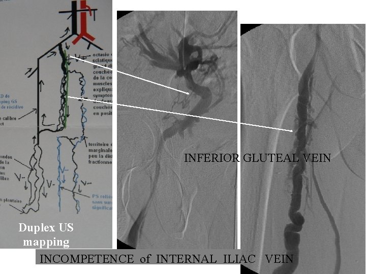 INFERIOR GLUTEAL VEIN Duplex US mapping INCOMPETENCE of INTERNAL ILIAC VEIN INFERIOR GLUTEAL VEIN Duplex US mapping INCOMPETENCE of INTERNAL ILIAC VEIN