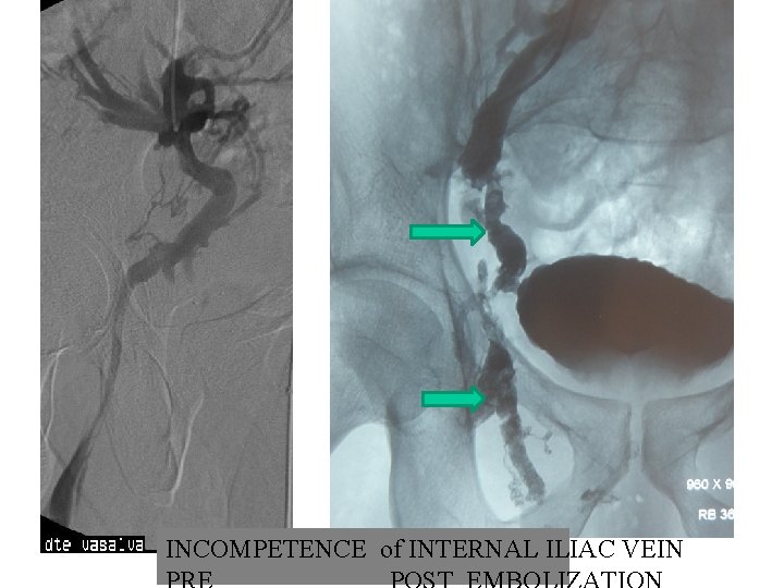 INCOMPETENCE of INTERNAL ILIAC VEIN INCOMPETENCE of INTERNAL ILIAC VEIN