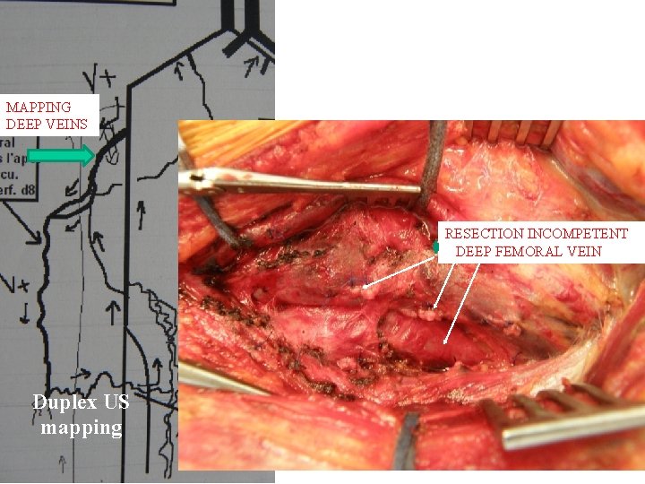 MAPPING DEEP VEINS RESECTION INCOMPETENT DEEP FEMORAL VEIN Duplex US mapping MAPPING DEEP VEINS RESECTION INCOMPETENT DEEP FEMORAL VEIN Duplex US mapping
