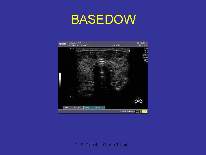 BASEDOW Dr. S. Pignata - Clinica Tricarico 