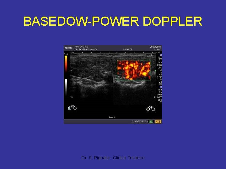 BASEDOW-POWER DOPPLER Dr. S. Pignata - Clinica Tricarico 