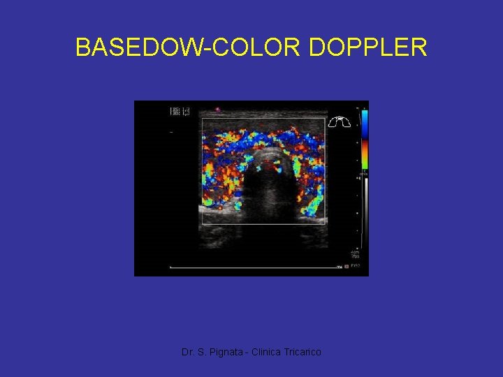 BASEDOW-COLOR DOPPLER Dr. S. Pignata - Clinica Tricarico 