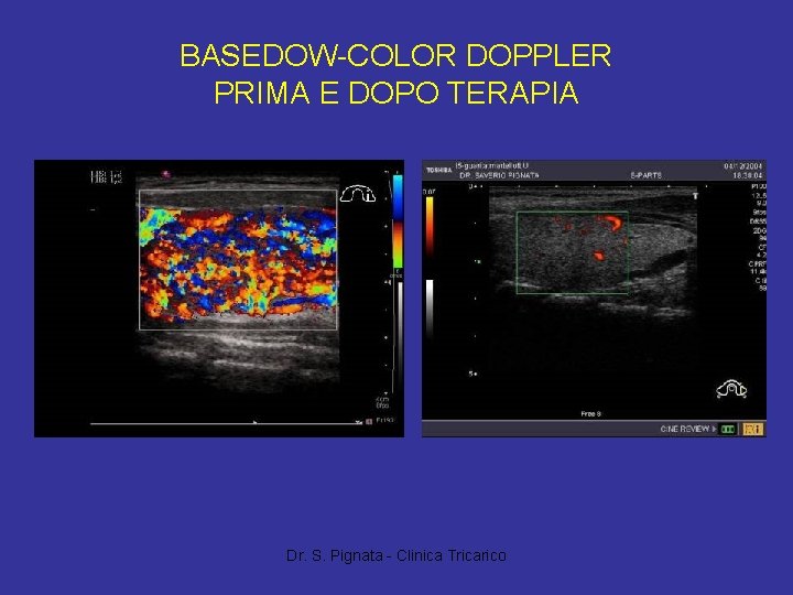 BASEDOW-COLOR DOPPLER PRIMA E DOPO TERAPIA Dr. S. Pignata - Clinica Tricarico 