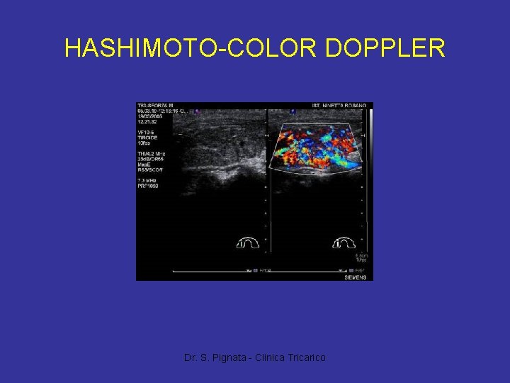 HASHIMOTO-COLOR DOPPLER Dr. S. Pignata - Clinica Tricarico 