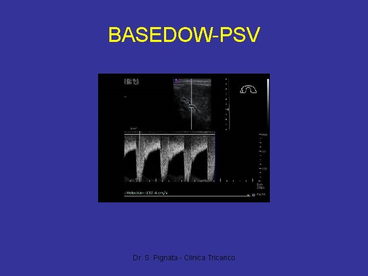 BASEDOW-PSV Dr. S. Pignata - Clinica Tricarico 