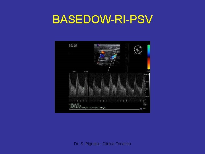 BASEDOW-RI-PSV Dr. S. Pignata - Clinica Tricarico 