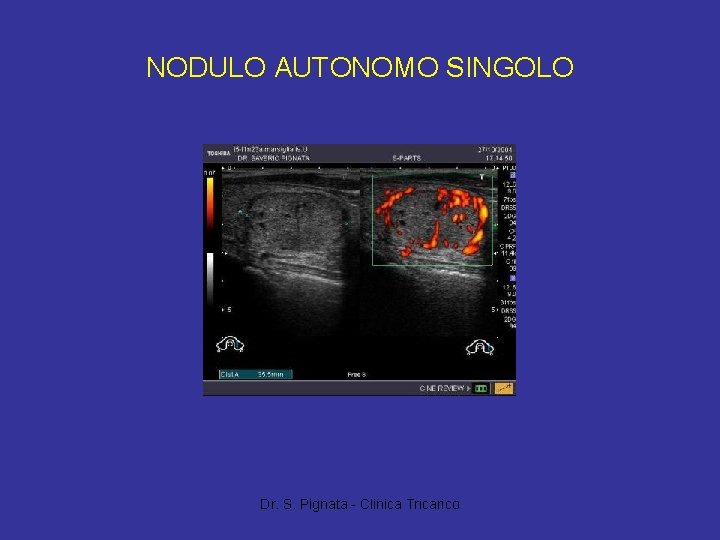 NODULO AUTONOMO SINGOLO Dr. S. Pignata - Clinica Tricarico 