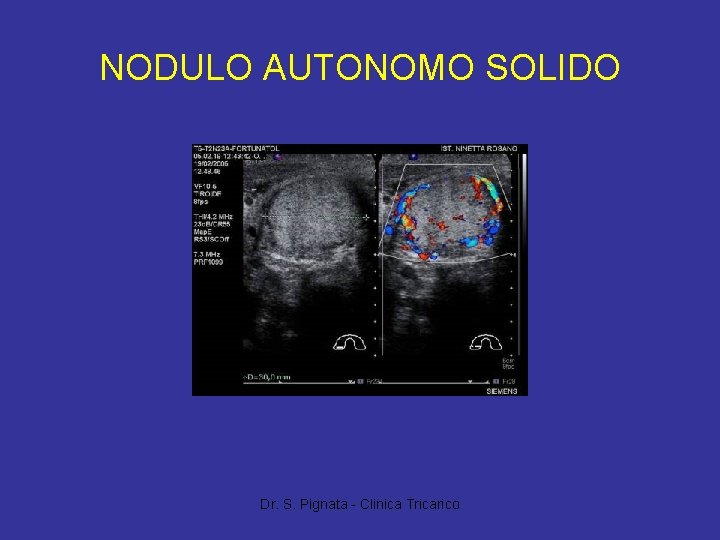 NODULO AUTONOMO SOLIDO Dr. S. Pignata - Clinica Tricarico 