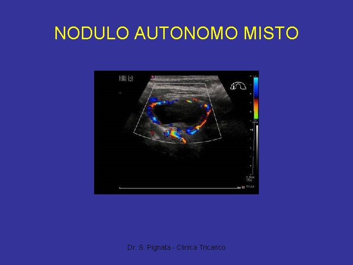 NODULO AUTONOMO MISTO Dr. S. Pignata - Clinica Tricarico 