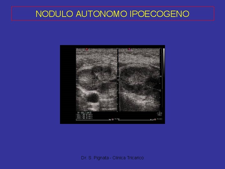 NODULO AUTONOMO IPOECOGENO Dr. S. Pignata - Clinica Tricarico 