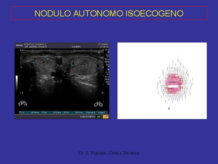 NODULO AUTONOMO ISOECOGENO Dr. S. Pignata - Clinica Tricarico 